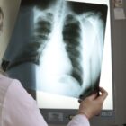 Profissional da saúde observa radiografia de pulmões